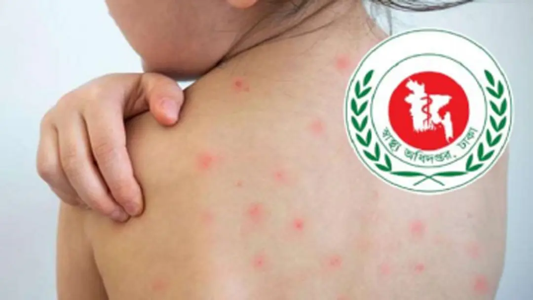 দেশজুড়ে হামের প্রাদুর্ভাব অব্যাহত: গত ২৪ ঘণ্টায় ৪ শিশুর মৃত্যু, আক্রান্ত সহস্রাধিক